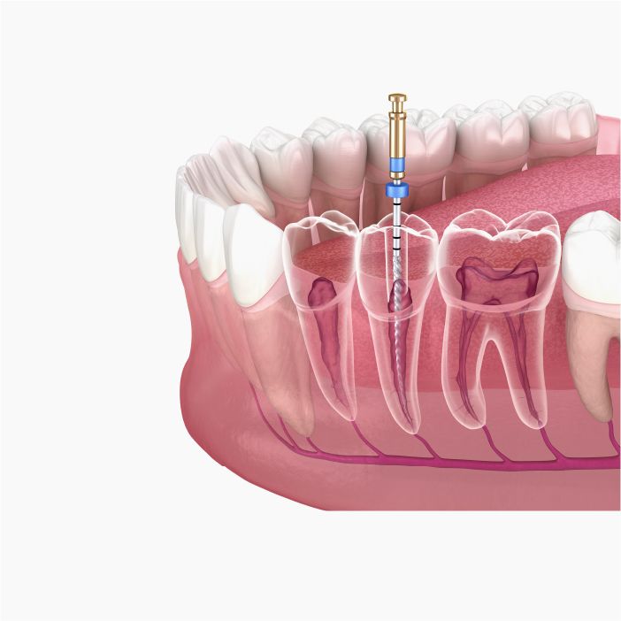 Root Canal | National Dental