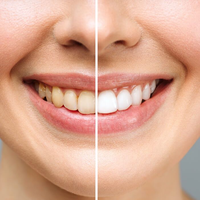 Benefits of Professional Teeth Whitening NYC | National Dental